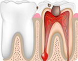 Shenzhen root canal treatment fees