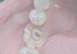 Shenzhen root canal fees