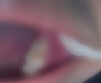 Recommended root canal treatment in Hong Kong