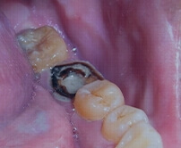Shenzhen root canal cost