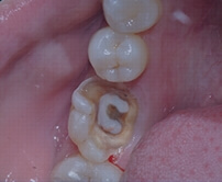 Shenzhen root canal fees