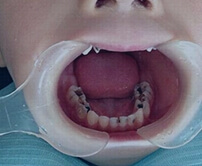 Shenzhen root canal fees