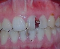 Hong Kong root canal fees