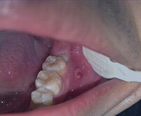 Hong Kong root canal prices