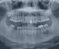 Hong Kong root canal fees