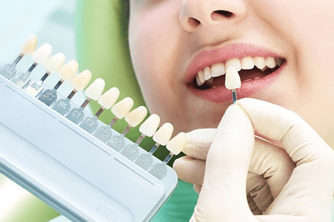 Shenzhen veneers price