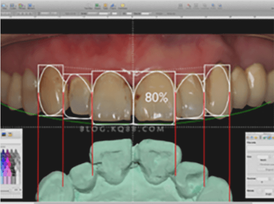 Hong Kong veneers cost