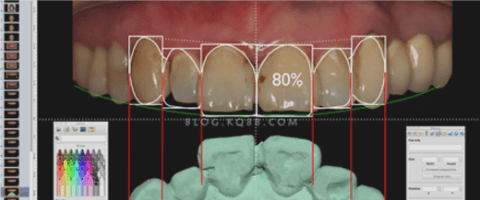 Hong Kong veneers price