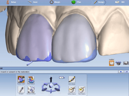Hong Kong veneers cost