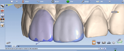 Hong Kong veneers price