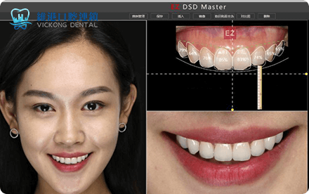 Shenzhen veneers price