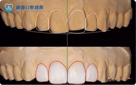 Shenzhen veneers price