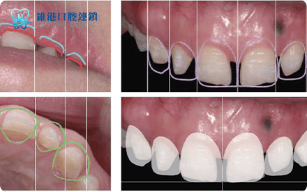 Shenzhen veneers cost