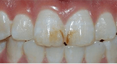 Shenzhen teeth whitening price