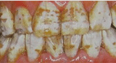 Shenzhen teeth whitening cost