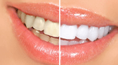 Shenzhen teeth bleaching price