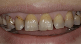 Shenzhen teeth whitening fee