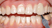 Shenzhen teeth bleaching best choice