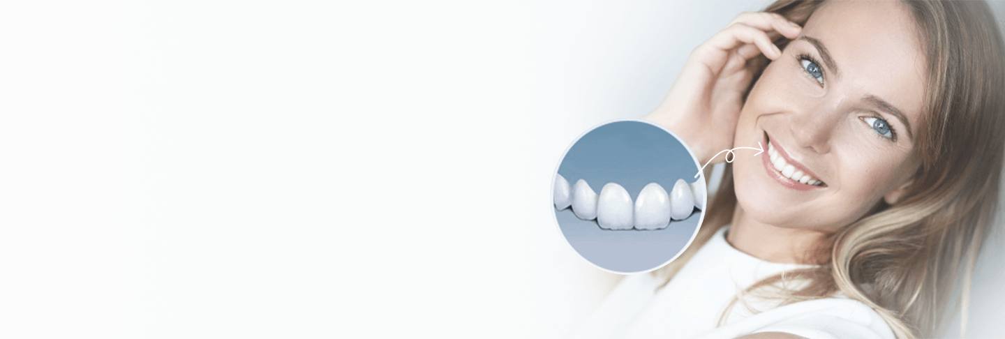 Shenzhen veneers price