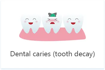 Wisdom Tooth Decay